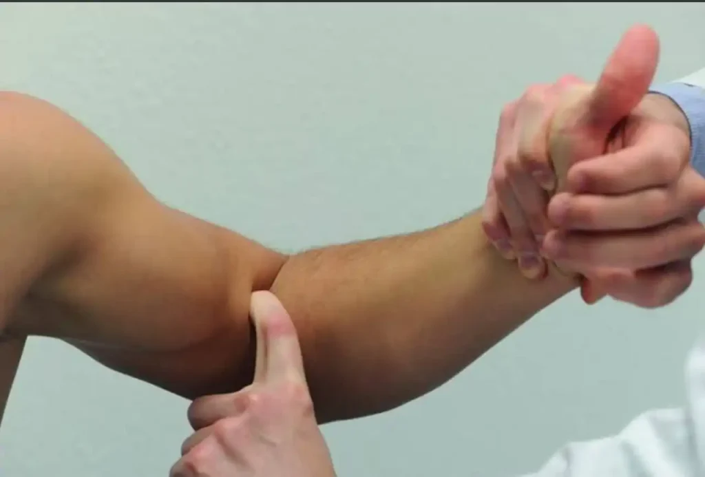 Ruptura do tendão do bíceps no cotovelo (bíceps distal)