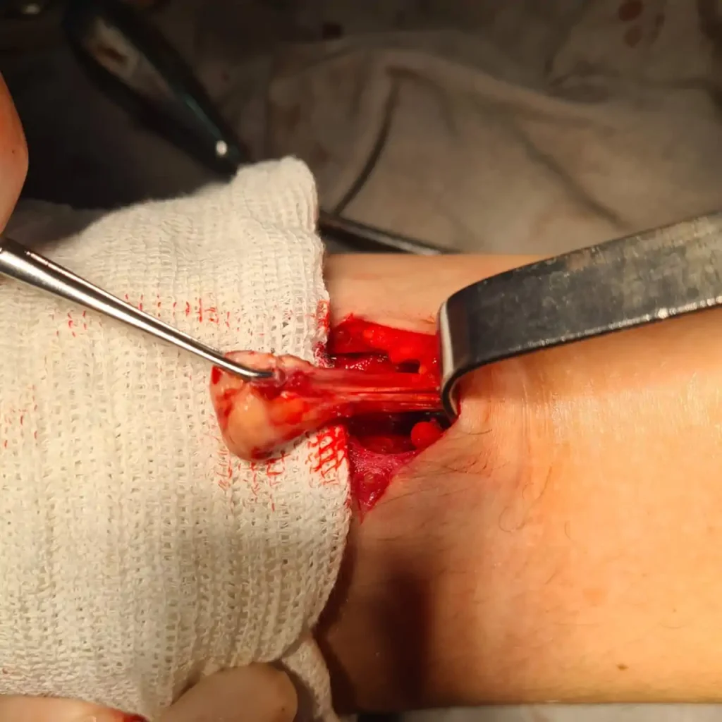 Ruptura do tendão do bíceps no cotovelo (bíceps distal)