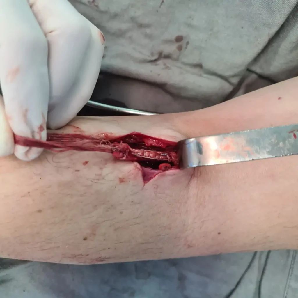 Ruptura do tendão do bíceps no cotovelo (bíceps distal)