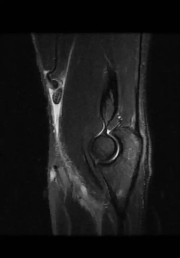 Ruptura do tendão do bíceps no cotovelo (bíceps distal)