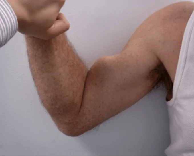 Ruptura do tendão do bíceps no cotovelo (bíceps distal)